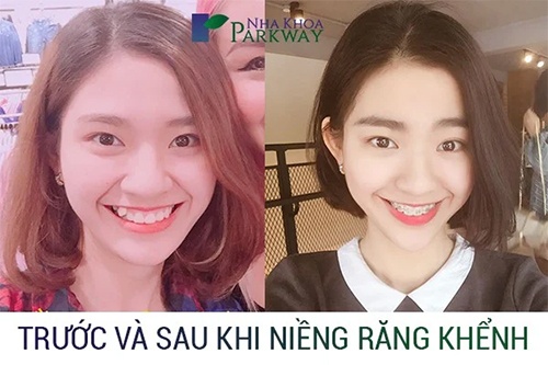Nieng Rang Khenh Co Can Nho Rang Khong (6)